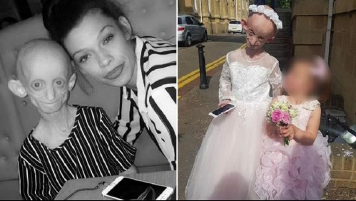 Joven que padecía la 'enfermedad de Benjamin Button' falleció a los 18 años