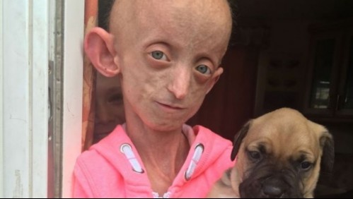 Joven de 18 años con la enfermedad de 'Benjamin Button' murió con un cuerpo de 144 años