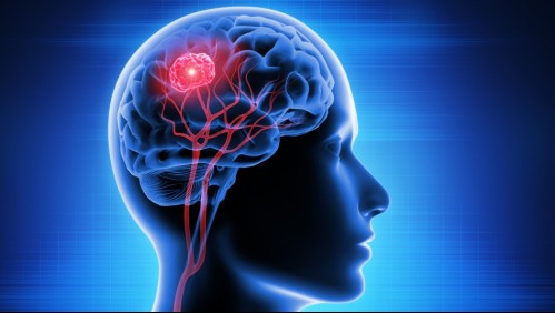 Prototipo de casco magnético podría combatir tumores cerebrales más agresivos