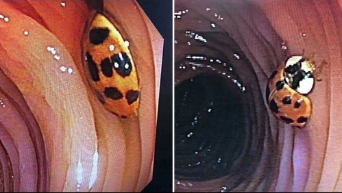 Encuentran un insecto viviendo en el intestino de un hombre de 59 años durante colonoscopia