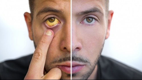 Cuida tu hígado: Conoce cómo reconocer los síntomas que indican que sufres de alguna enfermedad