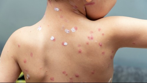 Herpes Zoster: Conoce los síntomas de la dolorosa enfermedad que puede afectar a los contagiados con varicela