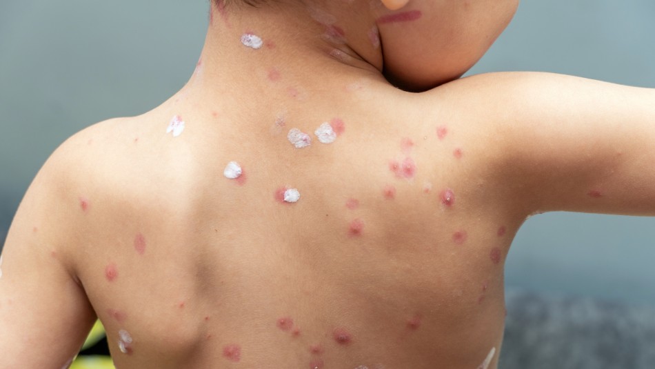Herpes Zoster: Conoce los síntomas de la dolorosa enfermedad que puede afectar a los contagiados con varicela