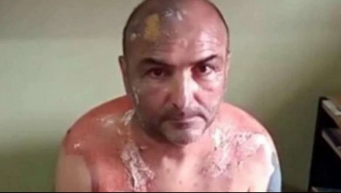 Hombre acusa ataque con agua hirviendo de su exesposa: 'Si hubiese sido yo el que hacía eso, me voy preso'