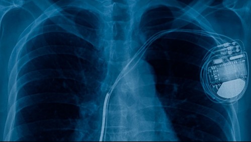 ¿Por qué recomiendan mantener el iPhone 12 lejos de los marcapasos?