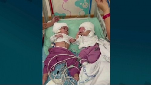 Una exitosa operación llevaron a cabo médicos que separaron a dos siamesas unidas por la cabeza en Israel