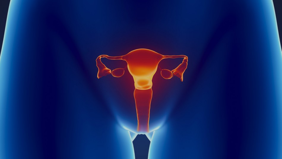 Cáncer de cuello uterino: Estos son los síntomas de la enfermedad