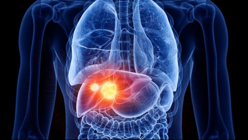 Cáncer de hígado: Los síntomas de la enfermedad y cómo puedes prevenirla