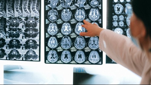 Avances en alzheimer: Nuevo algoritmo podría predecir la enfermedad en un 99%