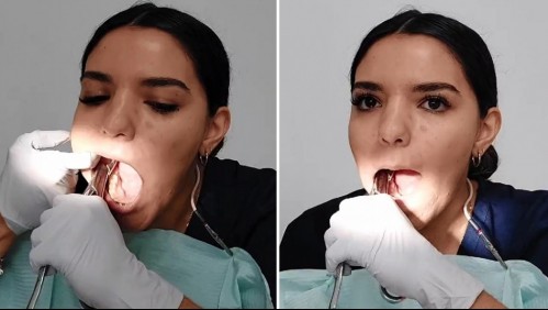 'No tengo más manos': joven dentista se quita las muelas del juicio sin ayuda y se graba mientras lo hace