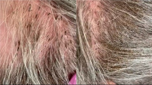 Tras caso de abuelita de 90 años hospitalizada por piojos: Así puede saber si sufres pediculosis