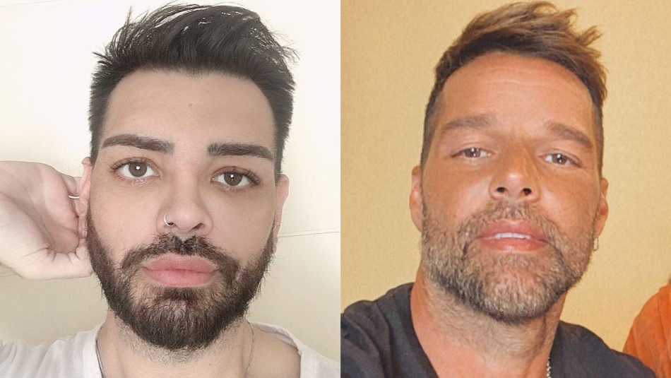 Así luce ahora joven argentino que se operó 30 veces para parecerse a Ricky Martin: 