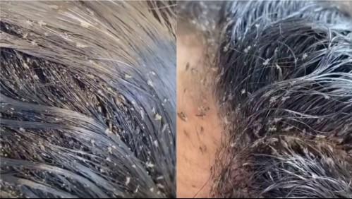 El impactante caso de una niña infestada por una plaga de piojos