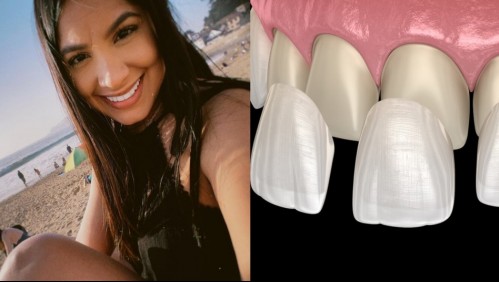 ¿Qué son las carillas? La solución dental y estética de la actriz Nathalie Vera de #PobreNovio