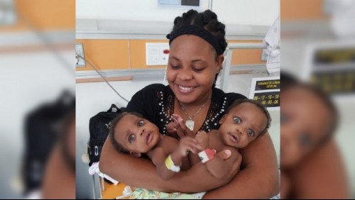 Siamesas son separadas tras exitosa cirugía que se prolongó por casi 15 horas