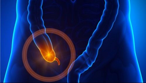 Apendicitis: Así es como puedes reconocer si tienes la enfermedad