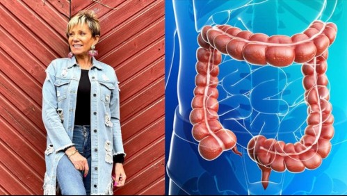 Colectomía: Así es la cirugía a la que debió ser sometida Raquel Argandoña