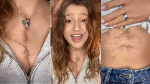 [VIDEO] Joven trasplantada recibió un corazón tan grande que ahora puede ver sus latidos a través de su pecho