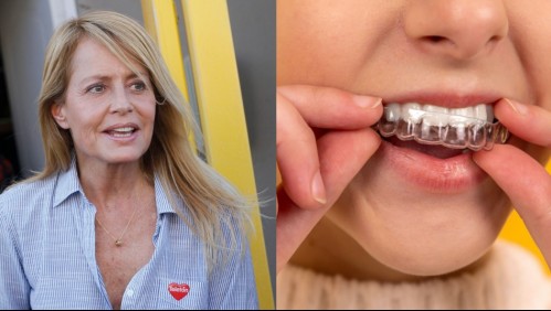 Bruxismo: La condición que obligó a Cecilia Bolocco a una intervención en sus dientes