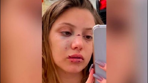 Joven es confundida con otra persona en una discoteca y le desfiguran la cara con una hielera