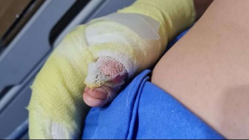 Niño sufre graves quemaduras tras explosión de experimento en feria científica