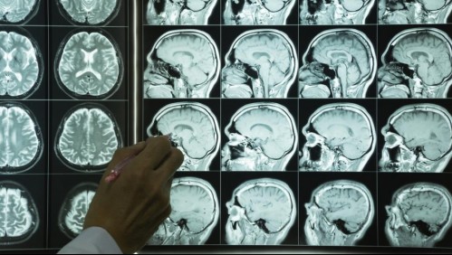 Mal de Alzheimer: Estas son las primeras señales con las que se manifiesta la enfermedad