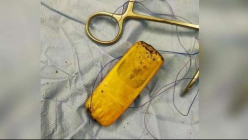 Se quejaba de un fuerte dolor estomacal y descubrieron un celular alojado en su intestino