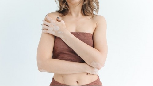 Para quienes deseen cubrir sus parches de vitíligo: Estas son las recomendaciones de los expertos