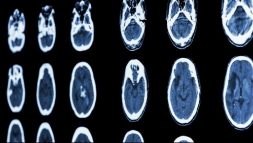 Neurólogo explica los síntomas de los accidentes cerebrovasculares