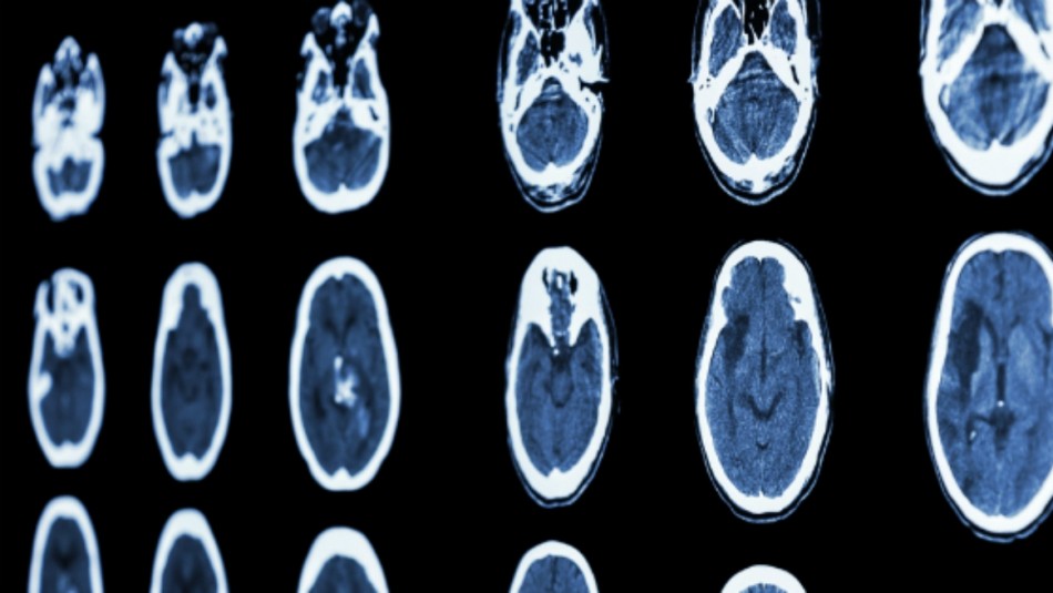 escaner-accidente-cerebrovascular Escáner cerebral