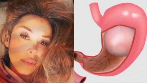 Balón intragástrico: Así funciona el procedimiento que ayudó a Romina Sáez a perder 13 kilos
