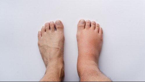 Atención a las piernas: Estos son los síntomas de una trombosis venosa profunda