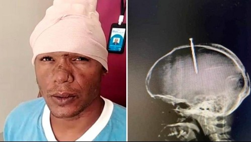 Médicos logran salvar a sujeto que se había incrustado un clavo en la cabeza
