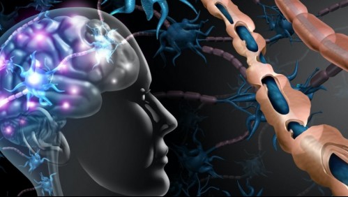 Esclerosis múltiple: Estos son los síntomas que advierten sobre la enfermedad