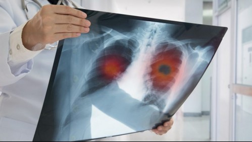 El más mortal en Chile: Estos son los síntomas del cáncer de pulmón