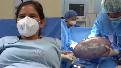 Médicos extraen un tumor 'gigante' de más de 6 kilos del estómago de una mujer de 28 años: 'Amenazaba su vida'