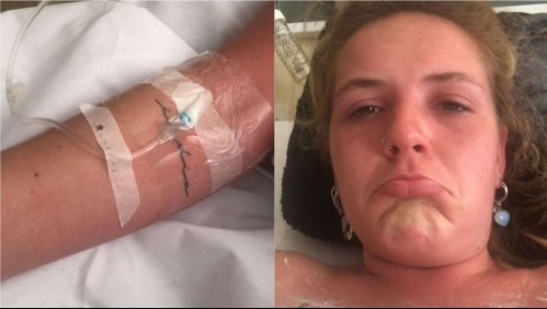 Mujer va al solárium y termina con el 90% del cuerpo quemado: 'Si se me seca la piel no puedo estirar el cuerpo'