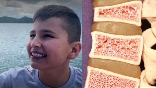 Mielitis transversa: Esta es la enfermedad que sufre el cadete de Palestino hospitalizado en Brasil