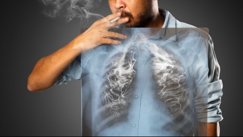 El más mortal en Chile: Estos son los síntomas del cáncer de pulmón