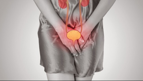 Así es como puedes identificar si es que tienes una infección urinaria