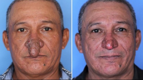 Severo caso de rinofima: Médico operó gratis a hombre que sufría compleja malformación en su nariz
