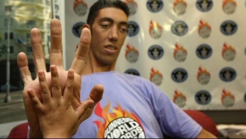 Acromegalia: Estos son 7 síntomas del trastorno que provoca crecimiento en los huesos