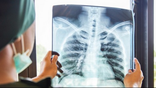 Cáncer de pulmón: Estos son los síntomas que indican que tus pulmones pueden estar fallando