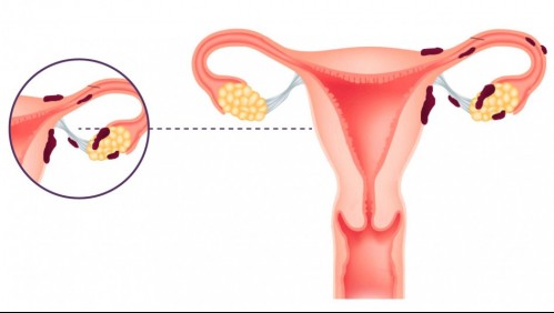 Endometriosis: ¿Cuáles son los cinco síntomas de la enfermedad?