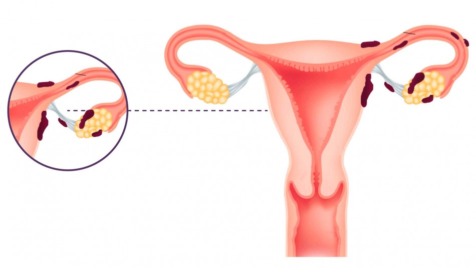 Endometriosis: ¿Cuáles son los cinco síntomas de la enfermedad? Endometriosis: ¿Cuáles son los cinco síntomas de la enfermedad?