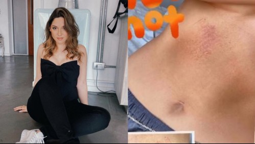 Se rasmilló hasta el abdomen: Kel Calderón muestra sus heridas tras sufrir estrepitosa caída mientras trotaba