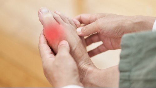 Gota: 6 señales que te permitirán reconocer la enfermedad