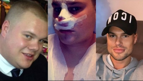 'Es una locura': Joven gastó más de 35 mil dólares en cirugías para modificar completamente su apariencia