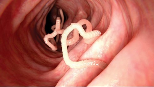 Lombriz solitaria: Los 4 síntomas que indican que el parásito habita en tu sistema digestivo