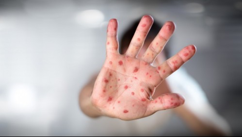 Una enfermedad altamente contagiosa: Estos son los síntomas del sarampión